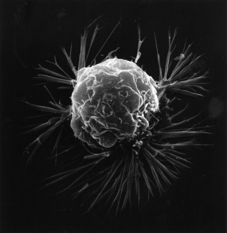 Cellule cancer sein