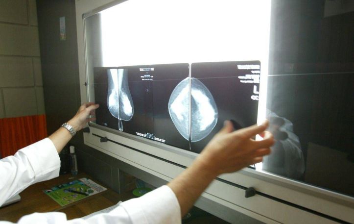 Radiographie cancer sein
