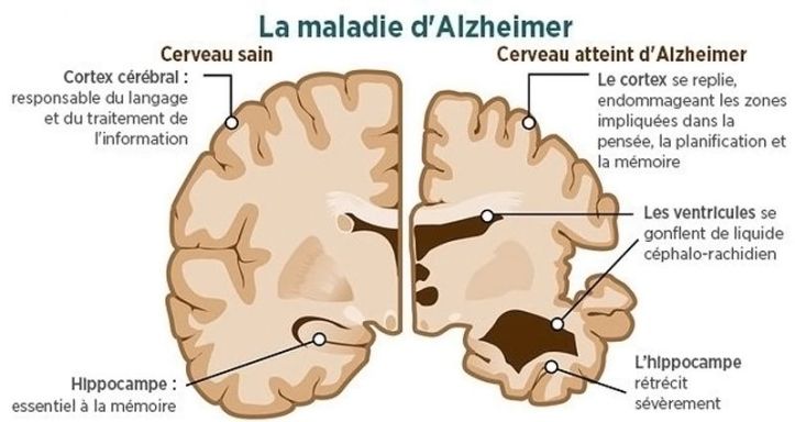 Cerveau - Alzheimer