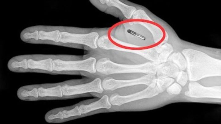 Microchip implant - Main - Hand