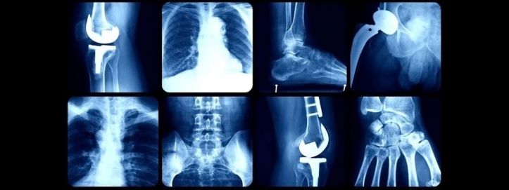 Implants et prothèses passés aux rayons X