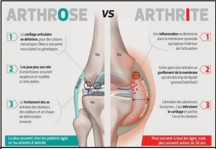Arthrite - 1